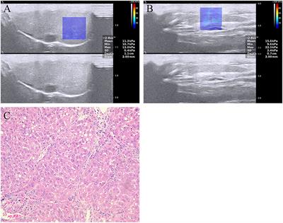 Quantitative Assessment of Portal Hypertension by Two-Dimensional Shear Wave Elastography in Rat Models of Nonalcoholic Fatty Liver Disease: Comparison With Four Composite Scores
